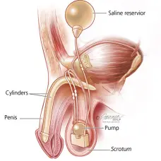 penile-implant-lightbox
